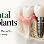Dental implant illustration showing the implant fixture, connecting abutment and replacement crown in the jawbone